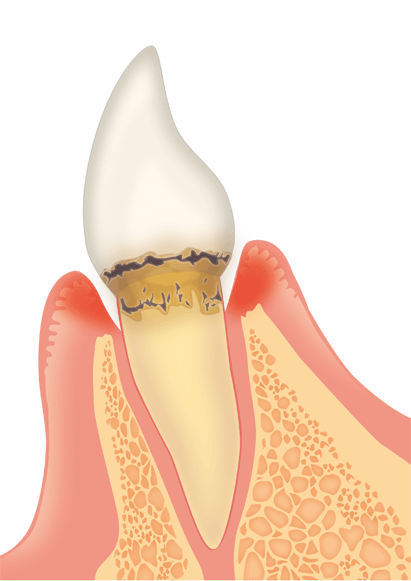 歯周病初期