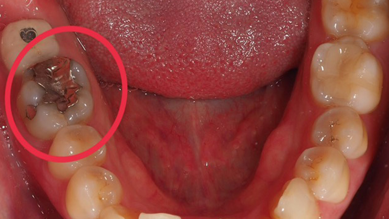 神経をとった歯は注意 代々木駅前歯科 矯正歯科 口腔外科