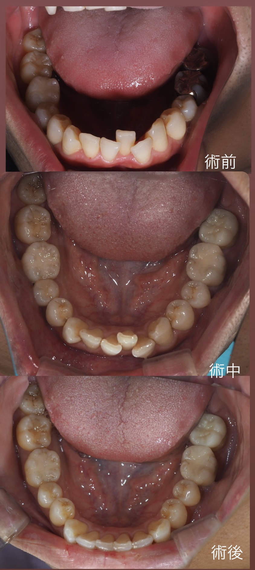 部分矯正について | 総合歯科治療の東京代々木駅前歯科・矯正歯科